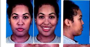 Double jaw surgery journey Dallas, TX (Dr. Steven Sherry) : r/jawsurgery