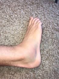 A grade 1 sprain occurs when there is only minor damage, and stretching of the ligaments. How To Quickly Heal A Sprained Ankle Vital Sage Sprained Ankle Sprained Ankle Remedies Treating A Sprained Ankle