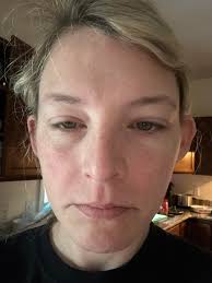 Has anyone had a severe eye reaction to a food?