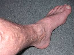 Sometimes, there is too much acid in the stomach which is not required for digestion. Varicose Veins Wikipedia