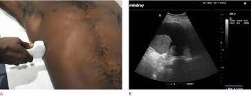 In this case we can see the liver, kidney, the diaphragm, and you can see that triangular wedge shaped area of black which is fluid or pleural effusion and you can actually see what we call the spine sign, which is the proximal thoracic ribs or lateral vertebral processes. Usg Ultrasonography Ultrasonography 2288 5919 2288 5943 Korean Society Of Ultrasound In Medicine 10 14366 Usg 17050 Usg 17050 Original Article Ultrasonographic Quantification Of Pleural Effusion Comparison Of Four Formulae Http Orcid Org 0000