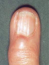 Is picking your cuticles and nails bad for you? Acd A Z Of Skin Digital Myxoid Cysts
