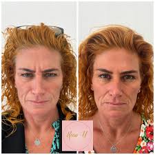 Photos represent one treatment of Seventy Hyal 2000 and is recommended to  have 3 for optimum results. This treatment is an injectable hyaluronic acid  skin booster treatment that aims to improve hydration