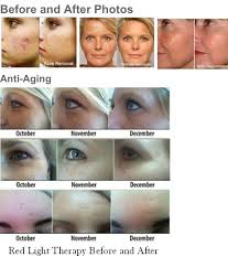 Redlighttherapy Before And Afters Rejuvenation Collagenstimulation Finelines And Wrinkles Be Gone Red Light Therapy Light Therapy Mask Light Therapy