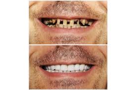 Dentist Before After Gallery, Family and Cosmetic Dentistry in 56425