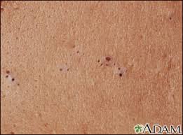 This is because, acne are known to heal leaving behind scarring of tiny black spots on skin. Acne Multimedia Encyclopedia Health Information St Luke S Hospital