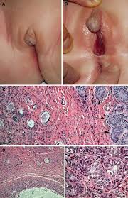 Image result for True Hermaphroditism