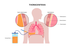 Image result for Thoracentesis