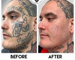 Tattoo removal volunteers—mds, nps, pas, and rns. Best Overview Helpful For Tattoo Removal Before And After An Overview New Fashion 365 2021