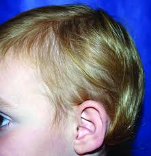As the most common reason for temple hairline recession, mpb is a condition characterized by hair thinning and loss over a period of time. What Is Your Diagnosis Mdedge Pediatrics