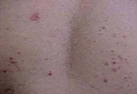 Skin biopsy from the deep keratotic areas will reveal marked epidermal hyperplasia and noncaseating epitheloid cell granulomas with lymphocytes and plasma cells in the. Scielo Brasil Cutaneous Tuberculosis Epidemiologic Etiopathogenic And Clinical Aspects Part I Cutaneous Tuberculosis Epidemiologic Etiopathogenic And Clinical Aspects Part I
