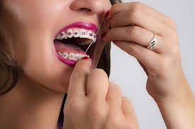 Learn tips for flossing with braces so that your teeth stay healthy. Tips For Flossing With Braces Belmar Orthodontics