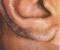 Before And After Ear Hair Removal
