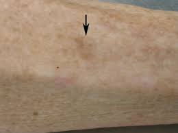 Image result for Pigment stains on the shin