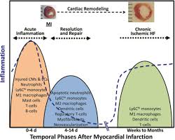 Image result for Myocardial Infarction Stabilization