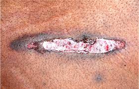 A wound is a type of injury which happens relatively quickly in which skin is torn, cut, or punctured (an open wound), or where blunt force trauma causes a contusion (a closed wound). Pathology Outlines Gunshot Wounds