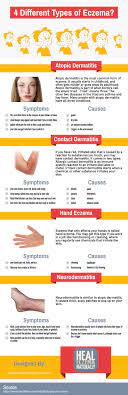 This Infographic Was Created By Heal Eczema Naturally The Most Common Type Of Eczema Is At Natural Eczema Treatment Atopic Dermatitis Home Remedies For Eczema