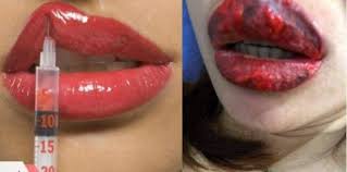Dengan begitu warna merah pada bibir dapat terpancing dan membuatnya tampak pink alami. Cara Menghilangkan Bibir Hitam Secara Alami Coba Gunakan 6 Cara Ini Theasianparent Indonesia