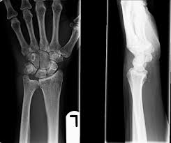 Image result for Pisiform Bone