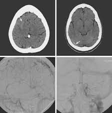 For the cerebral venous sinus thrombosis study group. Cerebral Venous Thrombosis Radiology Key