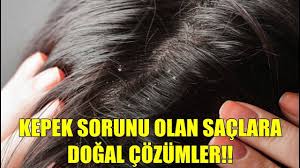 Dogal Yollardan Kepek Nasil Giderilir 11 Ipucu Kepek Sac Dogal Sac Bakimi