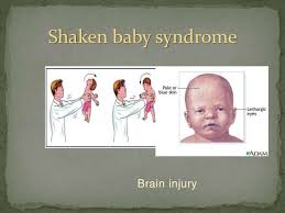 Shaken Baby Syndrome