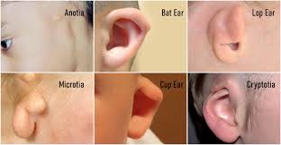 Taping or splinting of the auricle has been successful. Best Otoplasty Surgeon In Mumbai Usa England Uk Ear Reshaping Surgery Cost In Mumbai India Usa Prominent Ear Correction In Usa England