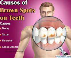 Brown spots, as well as other discolorations, have multiple causes. Sudden Brown Stains On Teeth Teethwalls