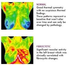Pin By Patricia Ryan On Health Mammogram Thermography Cancer Info