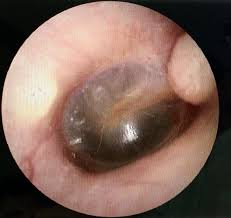 In an acute om, the eustachian tube that runs from the middle part of the ear to the back of the throat is blocked. Acute Otitis Media Amboss
