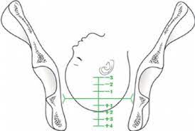 The Concept Of Conventional Fetal Station Delee S Station Is Defined Download Scientific Diagram