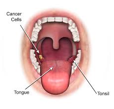The most common early warning sign of throat cancer is a persistent sore throat. Throat Cancer Symptoms Images Celine Dion Songs Age