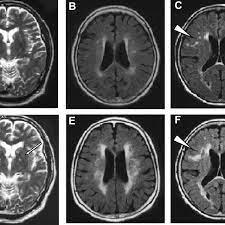 Example Of Small Vessel Disease Progression On Brain Mri Figures Show Download Scientific Diagram