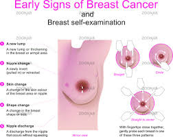 Irritation or dimpling of breast skin. Photo Signs Of Breast Cancer Image 11543465