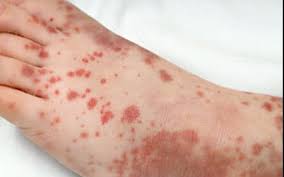 This condition is now more commonly referred to as immune thrombocytopenia (itp). Emdocs Net Emergency Medicine Educationimmune Thrombocytopenic Purpura Pearls And Pitfalls Emdocs Net Emergency Medicine Education