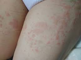 Image result for pruritic urticarial papules and plaques of pregnancy