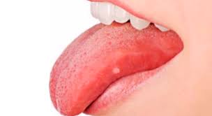 También llamadas aftas o úlceras bucales, se presentan en la zona interna de las mejillas, lengua, labios, encías o incluso en el paladar. Como Curar Las Llagas Que Aparecen En La Boca Blog