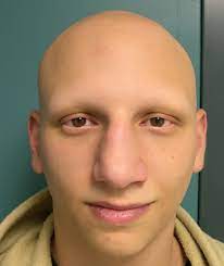 Hair Loss Remedies Hair Loss Causes Severe Hair Fall