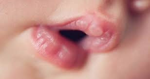 Die entwicklung der lippenbläschen kann gestoppt werden. Was Sie Tun Konnen Wenn Babys Herpes Haben