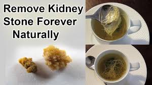 Without Surgery How To Pass A Kidney Stone Forever In 24 Hours It Scared Us When We Heard Abou Kidney Stones Kidney Stones Remedy Slow Cooker Recipes Meatloaf