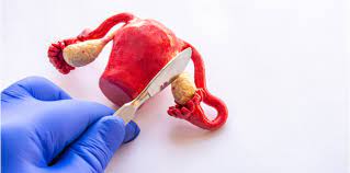 Neoplasms boleh menjadi sangat kecil, atau mereka boleh berkembang 15 cm atau lebih. Kesan Selepas Pembedahan Buang Rahim Wanita Ambil Tahu Ini