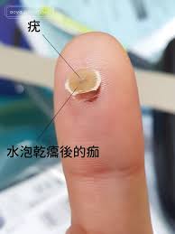 日記 疣與冷凍治療 千萬別拖啊 定安皮膚科 一個只有屁股的人 痞客邦 fruit cantaloupe food