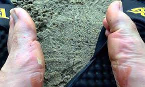 Whatever you do, do not pop a blood blister at home, warns dr. Blood Blisters On Feet What To And What Not To Do Health Tips