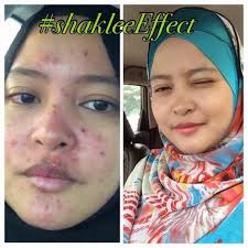 The name, chicken pox is vernacular for the varicella zoster virus. Hilangkan Parut Chicken Pox Yang Hodoh Dengan Cepat Mamaqaireen