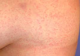If your skin child's skin stings with rubbing—and the rash appears under the swimsuit—he or she may instead have seabather's eruption from stinging larvae of sea symptoms are the worst in the first few days, but they are usually gone within a week. Zika Dr Rajiv Desai