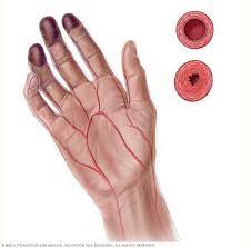Buerger disease - Symptoms and causes - Mayo Clinic
