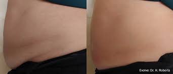 This will also affect the insulators' affinity with your equipment so. New Hands Free Customizable Skin Remodelling Evolve Tite