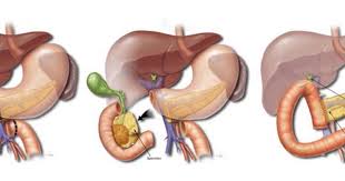 The Whipple Procedure Does Not Come Without Complications Learn About The Most Common Complications And How They Can Be T Whipple Procedure Whipple Procedure