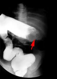 Image result for Intussusception