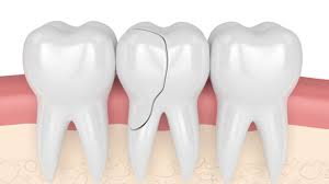 O que é um dente trincado?